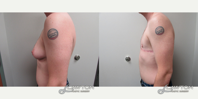 FTM Chest Masculinization Surgery - FTM Chest Masculinization Surgery