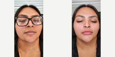 25-34 year old woman treated with Lip Fillers - Lip filler