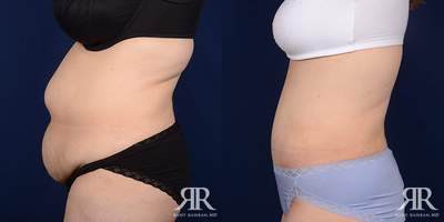 Tummy Tuck - Tummy Tuck