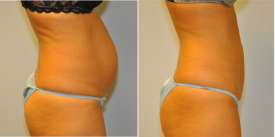 33 year old woman treated with Mini Tummy Tuck - 33 year old female with a large diastasis treated with a modified tummy tuck using a short incision drainless tummy tuck and floating umbilicus, with no belly button scar.