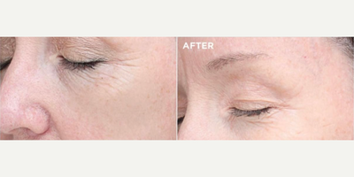 Woman treated with VI Peel - Improve sign of aging with our advance VI Peel.Improve lines and wrinklesImprove pigmentation and MelasmaGlows skinImprove skin tone
