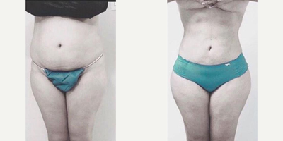 Woman treated with Brazilian Butt Lift - Woman treated with Brazilian Butt Lift
