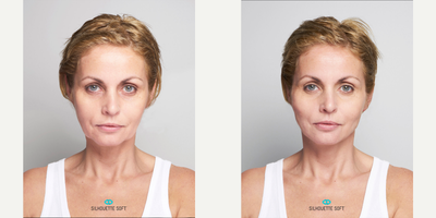 35-44 year old woman treated with Silhouette Soft - Threadlift lower face