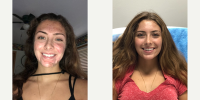 18-24 year old woman treated with Vi Peel - 1 VI Peel for Acne.