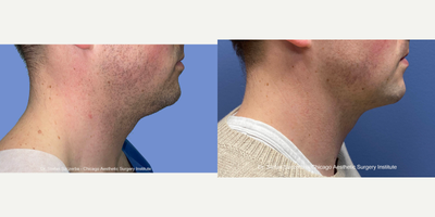 35-44 year old man treated with AccuTite - Patient was unhappy with his neck, and after a discussion, decided to have a procedure done using AccuTite on his neck.