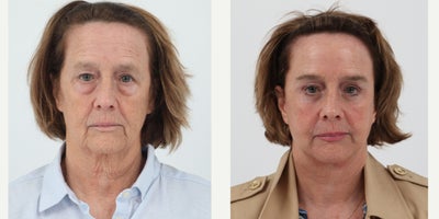 65-74 year old woman treated with Facelift, Neck Lift, Brow Lift, Eyelid Surgery, Facial Fat Transfer, CO2 Laser - 70 year old 3 months after a Facelift, Neck lift, brow lift, upper and lower bleph, fat transfer and co2 laser by Dr. Dilip D. Madnani.