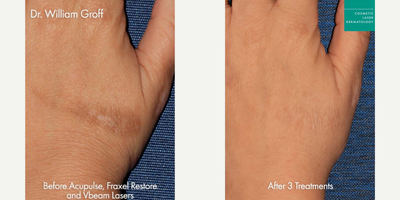 35-44 year old woman treated with Vbeam, Fraxel Laser - Vbeam, Fraxel Restore, and AcuPulse lasers to treat scar on hand
