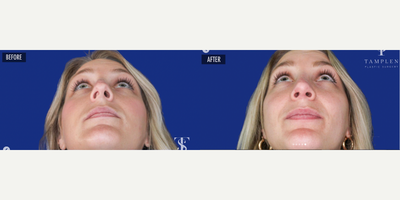 Woman treated with Rhinoplasty - Loving these results just 6 months post op from a complicated reconstructive #rhinoplasty.This patient was not able to breathe well and wanted a straighter nose that fit her face. All of my rhinoplasties consider form AND function, these should not be mutually exclusive when it comes to surgery involving the nose.Major septal reconstruction was performed (see bottom view) and her nose was refined to better fit her face. Now, she can breathe better than ever and loves her new look!