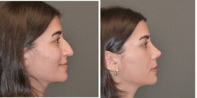 18-24 year old woman treated with Rhinoplasty - My lovely 23 years-old patient had rhinoplasty. She had extreme hump, hanging tip, deprojected tip and wide nasal base. I fixed and achieved excellent result with open rhinoplasty without tampon inside. It was a 2 hour operation under general anesthesia, 6 days later  removed the tapes, She still has some swelling and will be better in 3-4 months.