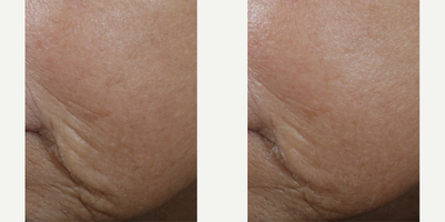 Skinbetter Science - InterFuse Intensive Treatment Cream Face & Neck.Photo provided courtesy of Skinbetter Science.