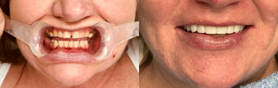 45-54 year old woman treated with Durathin Veneers - This journalist had broken teeth, missing teeth and extremely worn teeth. She had clenched her whole life. Suffering from PTSD and severe dental anxiety, she put off seeing the dentist and getting her teeth fixed. She finally decided she wanted to have a pretty smile. With planning, sedation and multiple appointments, she was able to have implants, crowns, dental bridges and veneers. The result is strong even bite, white straight teeth, and smoother face from regaining vertical dimension lost to worn and missing teeth.