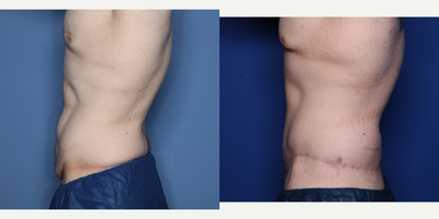 18-24 year old man treated with Body Lift, Male Tummy Tuck - 23 year old male shown 18 months after a lower body lift after he lost 150 pounds with diet and exercise.