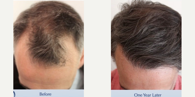 Broadway Bound Hairline (2537 grafts) - #BeforeAndAfterMondaysThis 37-year-old musical theater performer underwent a follicular unit extraction (FUE) session with Dr. Carlos K. Wesley in which a total of 2537 grafts were placed.  Next stop...Broadway (which, coincidentally, re-opens tomorrow!).Aspects of our surgical approach can be viewed on our sites Most Common Questions page. Three elements combined to help improve his experience: graft harvest, graft storage, and patient safety. Rather than a larger FUE punch used by a robotic approach, Dr. Wesley used a smaller caliber hand-held motorized punch to performed the donor harvest.  This approach better enabled the capture of donor intact hair roots that are slightly curved beneath the skin surface.  Upon completion of the harvest, the patients donor area was treated with PRP and A Cell in order to not only minimize scar tissue formation, but also encourage partial regeneration of donor hair follicles.Graft storage was optimized as hair follicles were incubated in autologous (his own) platelet rich plasma (PRP) throughout the duration of the procedure.  This, combined with an ATP-containing storage solution has been shown to enhance survival of transplanted hairs.Finally, having his procedure performed in our office with the highest standards of COVID precautions helped ensure patient safety. Every patient of Dr. Wesleys receives a rapid COVID test upon arrival to our office equipped with an ultraviolet air purification system. Measures such as reducing foot traffic by performing virtual consultations at no charge to patients, regular staff COVID testing and no-touch temperature checks of our team that avoids public transportation help preserve our clean and sanitary safe haven. Daily sterilization of the office coupled with the most rigid OR safety precautions further allay patient concerns in this sensitive time.   The patient returned one year after his procedure and images of the patient can be seen below.  This link illustrates the timing of hair growth after surgery. Similar patient hair transformations with Dr. Wesley and his team may also be viewed.