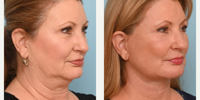 Woman treated with Facelift - This patient in her early 60s came in and wanted Dr. Balikians opinion on what she can do to look her best. Dr. Balikian recommended full facial rejuvenation to lead to the most beautiful result.Her results are beautiful and harmonious at 6 months.