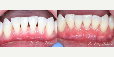 Gingival Graft using Alloderm - The patient has bone loss on the lower anterior.  Thickening the tissue will protect the teeth.