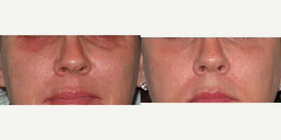 35-44 year old woman treated with Pixel Laser - Pixel ER treatment to face with focus on dark circles under eyes