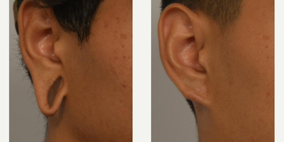 Man treated with Earlobe Repair - Man treated with Earlobe Repair