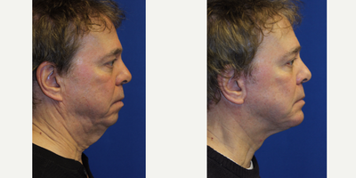 65-74 year old man treated with Facelift - This patient had undergone Ultherapy for fullness of the neck at an outside office. Because patient was still bothered by the heavy neck and jowl, he decided to pursue surgical treatment. Patient underwent face lift with chin implant, and is now very happy with the improvement.