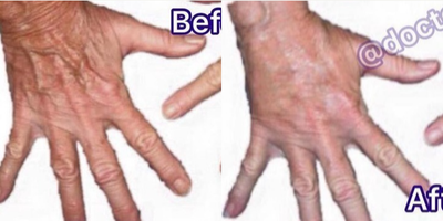 Woman treated with Hand Rejuvenation - I treated this patient with Radiesse injections to restore lost volume (making tendons & blood vessels less noticeable) & also performed intense pulse light (IPL) to remove sunspots. Upper photos are before treatment and lower photos are a month after. Painless, fast, and effective.