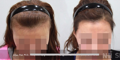 25-34 year old woman treated with Forehead Reduction - Forehead Reduction