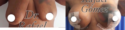 35-44 year old woman treated with Breast Lift - Breast lift without implants