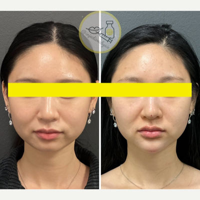 18-24 year old woman treated with NovaThreads, Thread Lift, Chin Filler, Nonsurgical Nose Job - This amazing transformation took a few sessions!Procedure: HA Filler- chin, PDO threads /HA filer to the nose. 