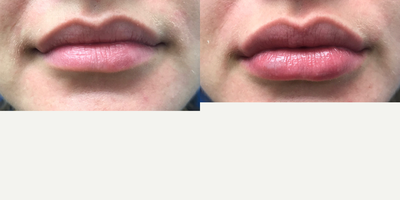 25-34 year old woman treated with Juvederm - Juvederm injection in the lower lip on a 25-year-old female.