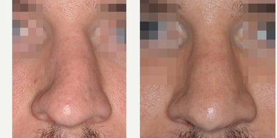 Revision Rhinoplasty - Pre and post 6 mo follow-up photos for revision rhinoplasty with rib cartilage for severely crooked nasal deformity