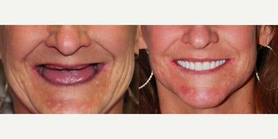 All-on-4 Dental Implants - All-on-4 Dental Implants