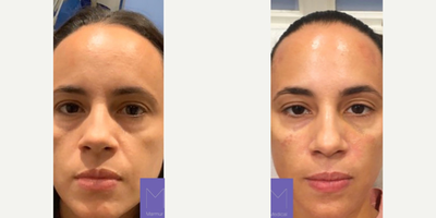 Woman treated with RHA Collection Fillers - Injectables and Fillers