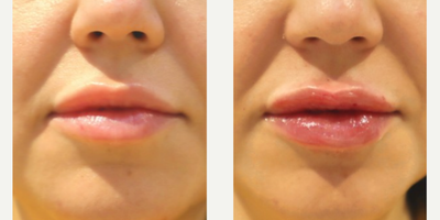 Woman treated with Lip Lift, RHA Collection Fillers - Injectables and Fillers