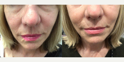 Woman treated with RHA Collection Fillers - Injectables and Fillers