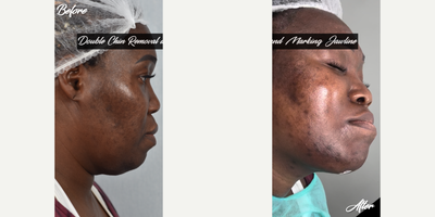 35-44 year old woman treated with Aqualyx, Botox, Kybella - i did double chin removal and marking jawline.