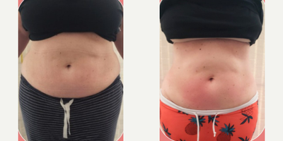 Woman treated with Cryoskin - After her first two sessions and wanting to tighten after also losing weight with our Semagltuide for medical weight loss, she bought an entire pack of treatments! These results are after 4 sessions.