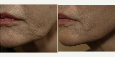 65-74 year old woman treated with Evoke - 66 year old female following a series of Evoke radio frequency treatments of the face and neck.