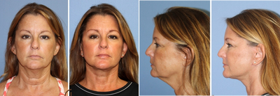 55-64 Year Old Woman Treated with Neck Lift - No General Anesthesia - Dr. Kevin Sadati performed a neck lift with a lower face lift on this patient. No general anesthesia was needed. Only local anesthesia with twilight sedation was used to provide a comfortable experience for the patient. Recovery was smooth and downtime was quick thanks to Dr. Sadati's facelift technique. Only two months after her neck lift surgery.