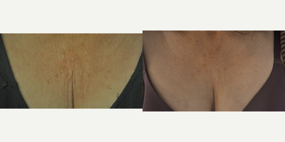 55-64 year old woman treated with Exilis Ultra - The Exilis Ultra is an extremely versatile device, able to tighten skin on almost any body part, head to toe. Here we had great results on this woman's decollete after 4 treatments.