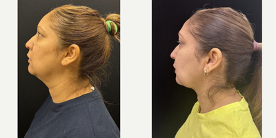 45-54 year old woman treated with FaceTite - Chin and neck liposculpting, facetite