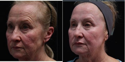 55-64 year old woman treated with Skin Tightening, Laser Resurfacing, Lip Fillers - LaserCoring for full face & NECK
