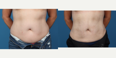 45-54 year old woman treated with Liposuction - Patient's abdominal area was thinned out with liposuction