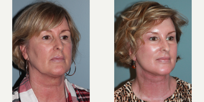 55-64 year old woman treated with Blue Peel - This patient had a LiteLift, Chin augmentation, Temple lift, Blue Peel, and neck lift were performed simultaneouslyon an out patient basis under general anesthesia.After photos were taken 7 months post-op.
