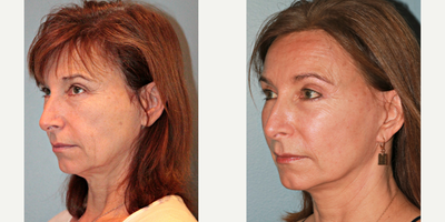 61 year old woman treated with Blue Peel - This patient underwent a Blue Peel, LiteLift, upper and lower eyelids, and fat transfer to cheeks. She had little bruising or swelling at 3 weeks post-op, which is one of the many benefits of our LiteLift facelift procedure. Results are also very natural as you can see in her pictures. After photos were taken 9 months post-op.