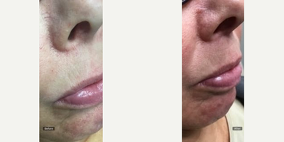 35-44 year old woman treated with Vein Treatment - Before and After of a VeinGogh Treatment (Ohmic Thermolysis) a unique microburst technology