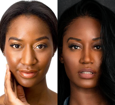 35-44 year old woman treated with African American Rhinoplasty - 35-44 year old woman treated with African American Rhinoplasty