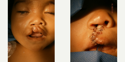 17 or under year old man treated with Cleft Lip And Palate Repair - This is a unilateral Cleft Lip, with a Millard II technique it was posible to give a smile back to this child