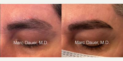 Patient treated with Eyebrow Transplant - Patient treated with Eyebrow Transplant