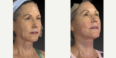 65-74 year old woman treated with Facelift - This very pretty woman was concerned about her jowl area and the excess skin under her neck. We did a lower face and neck lift with platysmaplasty.  Looking good!