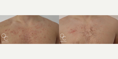 25-34 year old man treated with ResurFX - Before and after 4 sessions of nonablative Resurfx laser to acne scarring on the chest