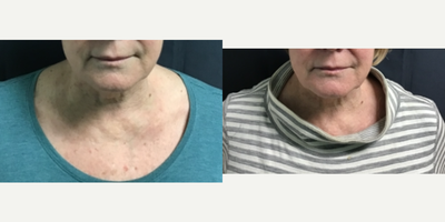 65-74 year old woman treated with Pelleve - Pelleve on lower face and neck before 1st treatment and 3rd treatment.