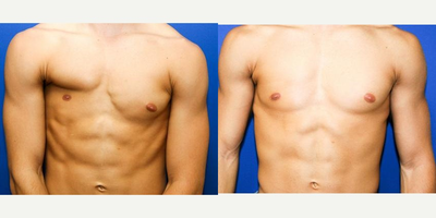 18-24 year old man with Poland Syndrome treated with Breast Reconstruction with muscle flap - Poland Syndrome

A 21-year-old plastic surgery patient presented to our office for consultation regarding correction of a very rare breast/chest deformity called Poland Syndrome. He was otherwise very healthy, athlete. After through clinical evaluation we found that his deformity is mild to moderate and that he is only missing a portion of the chest muscle (pectoral muscle, peck muscle). More severe forms of this deformity include loss of the ribs with chest deformity, as well as deformity of the upper extremity. We discussed complex reconstructive breast procedure which will include transfer of a live muscle from his back to replace missing pectoral muscle.

His surgery was done in hospital in general anesthesia. It involved preparation and transfer of a powerful latissimus dorsi muscle from his back to the front; muscle was fixed to the ribs in the same position as a missing pectoral muscle to create symmetry with opposite site.

Patient is shown before surgery on the left; notice severe asymmetry between left and right breast/chest. On the right patient is shown 3 years after surgery; he was able with exercise to build transferred muscle to match the size of a contralateral muscle. He has a small scar in the right armpit which is the only reminder of previous condition.